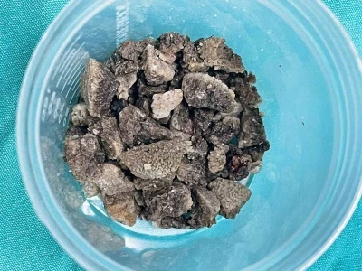 8 santimetrelik ’geyik boynuzu’ böbrek taşı kapalı yöntemle çıkarıldı
