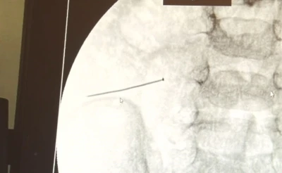 Ağrıyla kıvranan 2 yaşındaki çocuğun bağırsağından 3 santimlik iğne çıktı
