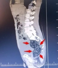 Batman&rsquo;da yabancı uyruklu bir şahsın midesinden 64 par&ccedil;a uyuşturucu &ccedil;ıktı