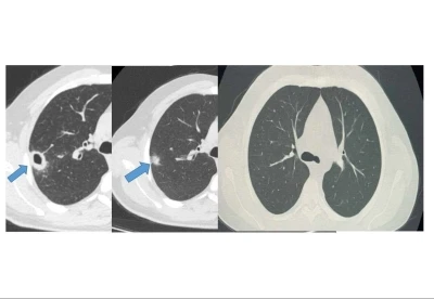 Bayburt’ta 50 yaşındaki hasta erken tanıyla sağlığına kavuştu
