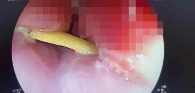 Boğazına saplanan 5 santimlik kemik &ouml;ld&uuml;r&uuml;yordu
