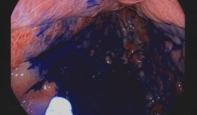 Boyama yöntemi ile mide ve bağırsak kanserinde erken teşhis
