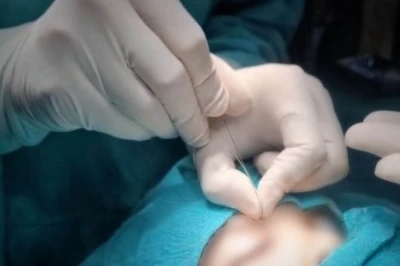 &Ccedil;ukurca&rsquo;da g&ouml;zyaşı kanalı ameliyatları yapılmaya başlandı
