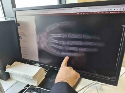 Eskişehir&rsquo;de her ay 5 ila 7 &ccedil;ocuğa kanser tanısı konuluyor
