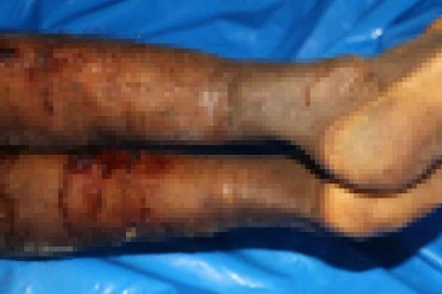 İsrail’in iade ettiği cenazelerde işkence izleri görüldü
