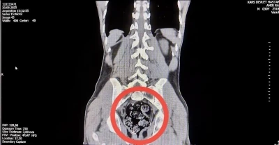 Kars’ta İranlı kuryenin makatından uyuşturucu çıktı
