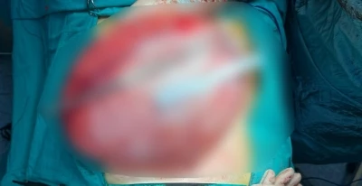 Kilo vermek i&ccedil;in hastaneye giden &ccedil;ocuğun karnından 3,5 kiloluk kist &ccedil;ıktı
