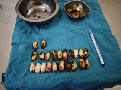 Midesinde taşıdığı uyuşturucu maddeler polisin dikkatinden sayesinde ele ge&ccedil;irildi
