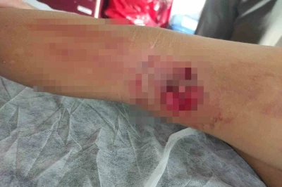 Okula giderken sokak köpeğinin saldırısına uğradı
