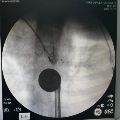 Siirt&rsquo;te boğazına madeni para ka&ccedil;an &ccedil;ocuk, doktorların m&uuml;dahalesi ile kurtarıldı
