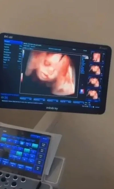 Sinop Atatürk Devlet Hastanesi’ne 4 boyutlu ultrason cihazı
