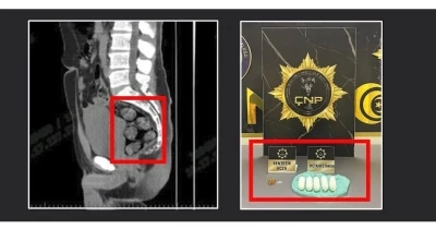 Tomografide şok eden görüntü...Uyuşturucu midesinden çıkarıldı
