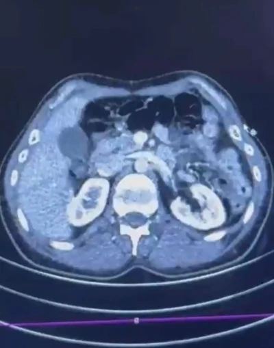 Ülkeye midelerinde uyuşturucu getiren şahıslar yakalandı
