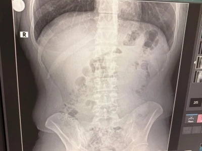 Uşak’ta midelerinden uyuşturucu çıktı: İranlı 3 kişi tutuklandı
