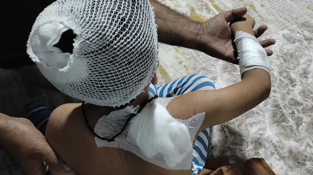 Viranşehir'de köpek saldırısında 8 yaşındaki çocuk yaralandı