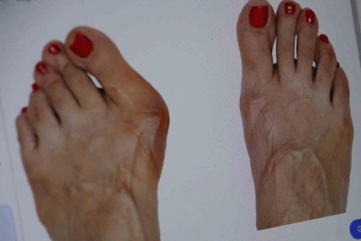 Topuklu ve sivri burun ayakkabı giyenler dikkat: Parmağınızın anatomisi bozulabilir
